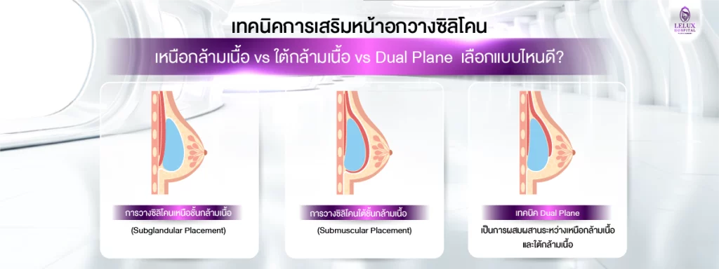 เทคนิคการเสริมหน้าอก วางซิลิโคนใต้กล้ามเนื้อ vs เหนือกล้ามเนื้อ vs Dual Plane เลือกแบบไหนดี?