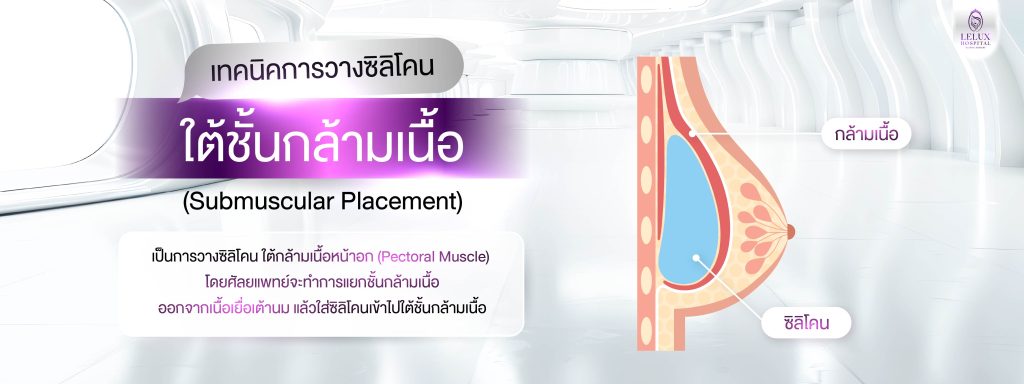 1. เทคนิคการวางซิลิโคนใต้ชั้นกล้ามเนื้อ (Submuscular Placement)