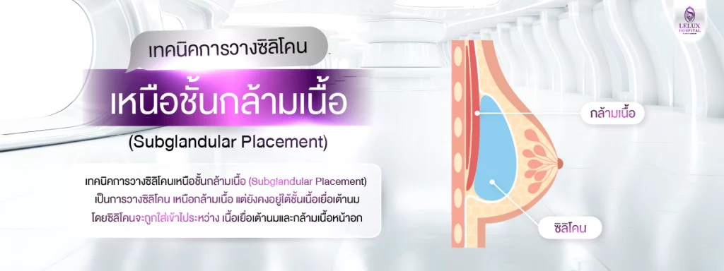 เทคนิคการวางซิลิโคนเหนือชั้นกล้ามเนื้อ (Subglandular Placement)