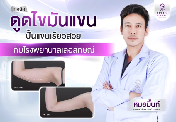 ดูดไขมันแขน ปั้นแขนเรียวสวยกับโรงพยาบาลเลอลักษณ์ ปลอดภัย เห็นผลไว