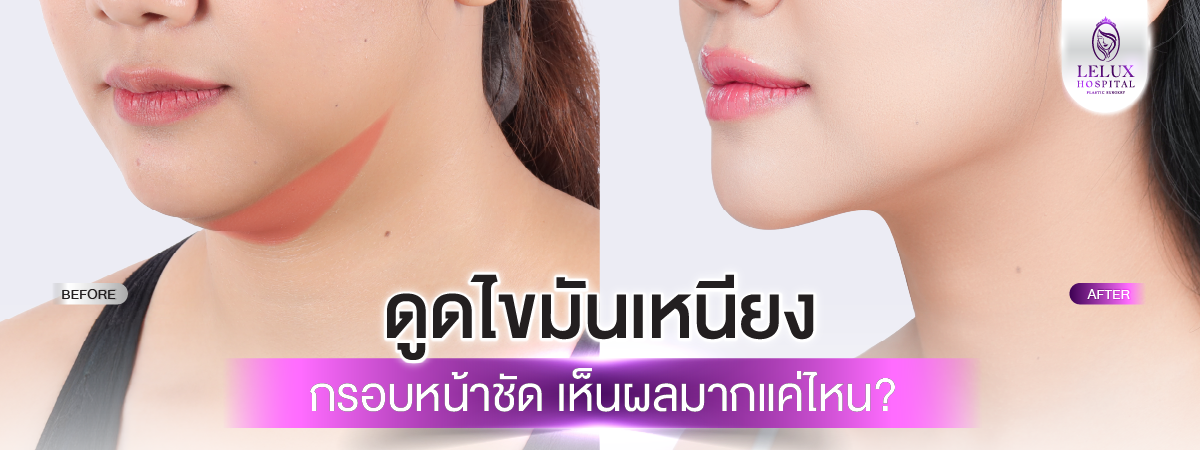 ดูดไขมันเหนียง กรอบหน้าชัดจริงไหม? เห็นผลแค่ไหน