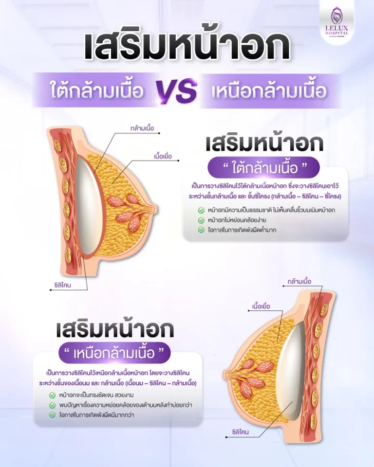ภาพเปรียบเทียบการเสริมหน้าอกใต้กล้ามเนื้อและเหนือกล้ามเนื้อ พร้อมตำแหน่งการวางซิลิโคน
