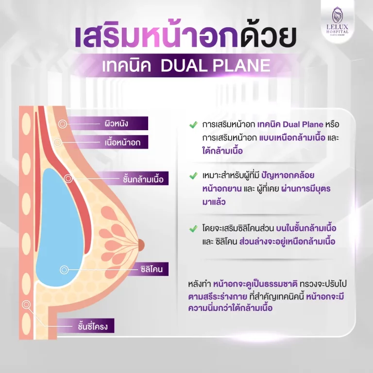 ภาพอธิบายการเสริมหน้าอกด้วยเทคนิค Dual Plane วางซิลิโคนร่วมกันทั้งใต้กล้ามเนื้อและเหนือกล้ามเนื้อ