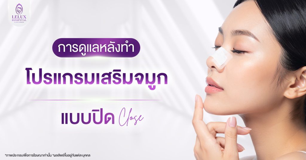 การดูแลหลังทำเสริมจมูกแบบปิด