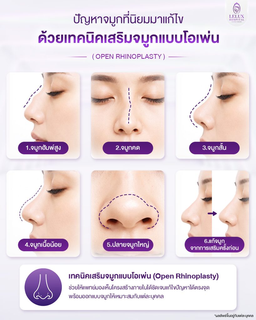 ปัญหาจมูกที่นิยมมาแก้ไขด้วยเทคนิคเสริมจมูกแบบโอเพ่น