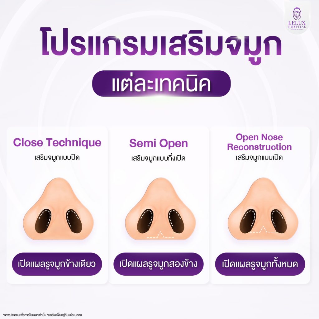 ศัลยกรรมเสริมจมูก Semi Open กับแบบ Open ต่างกันอย่างไร
