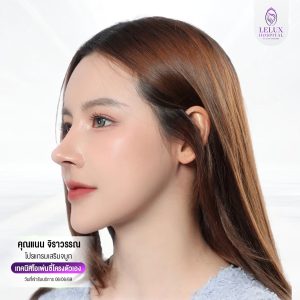 รีวิวเสริมจมูกโอเพ่นที่เลอลักษณ์