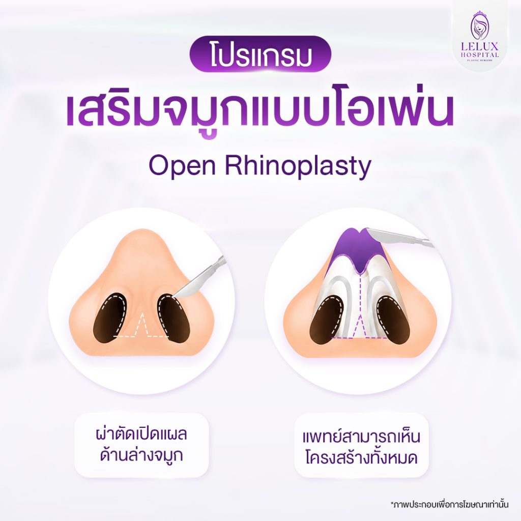 เสริมจมูกแบบโอเพ่น คืออะไร
