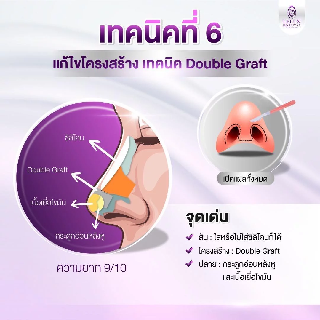 เทคนิคที่ 6 แก้ไขโครงสร้างยืดผนังกั้นจมูก ด้วย Double Graft