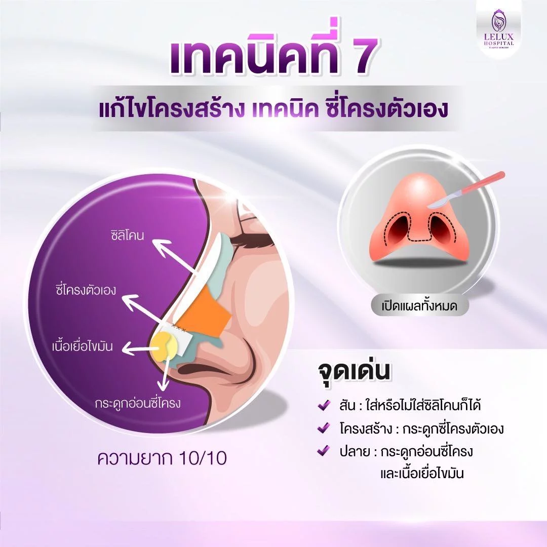 เทคนิคที่7 แก้ไขโครงสร้างยืดผนังกั้นจมูกด้วย ซี่โครงตัวเอง
