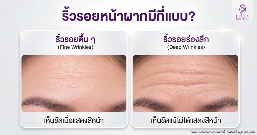 ริ้วรอยหน้าผากมีกี่ประเภท อะไรบ้าง