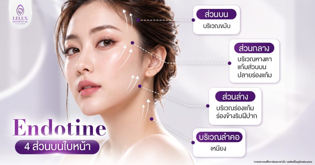 หมุดเอนโดไทน์ (Endotine) มีกี่แบบ